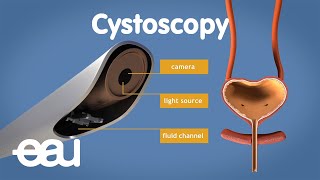 UroLift® System Procedure Animation [upl. by Noffihc]