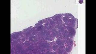 Histopathology Lymph nodeMantle cell lymphoma [upl. by Raddie]