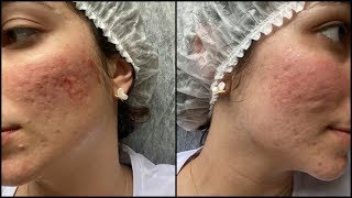 3ª Sessão do Microagulhamento para cicatrizes de acne  Dermapen [upl. by Ahselyt]