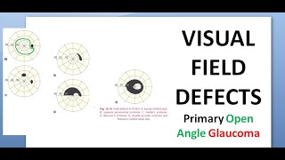 Ophthalmology 236 c Visual Field Defects POAG Primary Open Angle Glaucoma Treatment Laser Surgery [upl. by Noved]