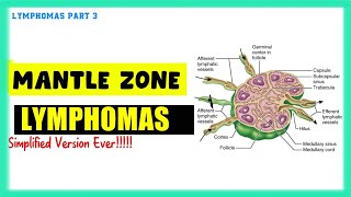 Mantle Zone Lymphoma Simplified  Speedy Medical [upl. by Petty]