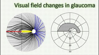 Visual field changes in glaucoma [upl. by Ariuqahs]