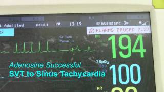 SVT or Supraventricular Tachycardia [upl. by Nahtnhoj340]