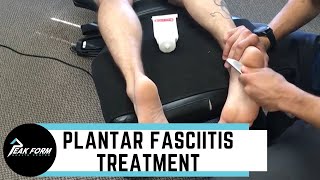 Plantar Fasciitis Treatment San Diego Graston Chiropractic [upl. by Eachern]