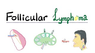 Follicular Lymphoma  Indolent BCell Lymphoma  NonHodgkin’s Lymphoma  Hematology [upl. by Susy102]