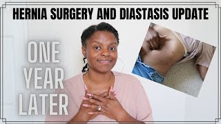 Hernia Repair Surgery amp How Does Diastasis Recti Look  ONE YEAR LATER [upl. by Claresta]