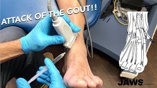 Injecting a GOUTy ankle joint [upl. by Mcloughlin]