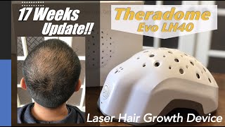 17 Weeks Update  Theradome EVO LH40 Laser Hair Growth [upl. by Zurek447]