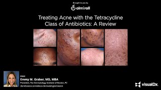 Treating Acne with the Tetracycline Class of Antibiotics A Review [upl. by Emawk]