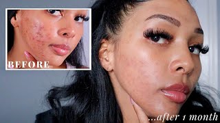 SPIRONOLACTONE CHANGED MY SKIN UPDATE AFTER 1 MONTH  NEW JOURNEY TO CLEAR SKIN PT 5 [upl. by Yert]