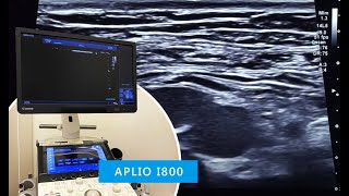 Diastasis recti clinical exam amp ultrasound imaging [upl. by Erek]