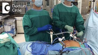 How long does it take to recover from Laparoscopic Surgery  Dr Beena Jeysingh [upl. by Adnovoj929]