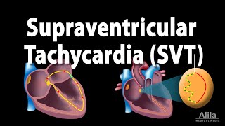 Supraventricular Tachycardia SVT PSVT Animation [upl. by Kohsa]