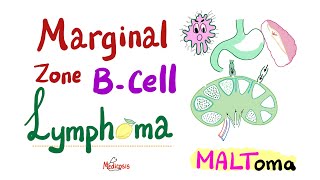 Marginal Zone BCell lymphoma MALToma  Indolent BCell NonHodgkin’s Lymphoma  Hematology Onco [upl. by Neiluj210]