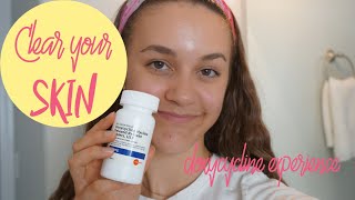 How To Get Rid of Acne  My Doxycycline Experience [upl. by Notlad]