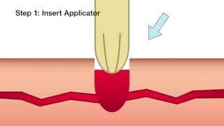 Celox A Applicator Hemostatic Plunger  Training [upl. by Mercuri]