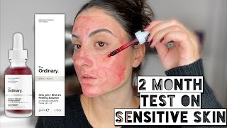 THE ORDINARY AHA 30  BHA 2 PEELING SOLUTION ON ACNE PRONE SENSITIVE SKIN  2 Month Test [upl. by Giralda573]