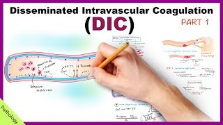 DIC Disseminated Intravascular Coagulation  Part 1 [upl. by Maller617]