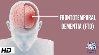 Engaged caregiving and stageappropriate activity for individuals with frontotemporal dementiam4v [upl. by Jane]