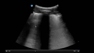 POCUS  COVID Lung Ultrasound [upl. by Edmead]